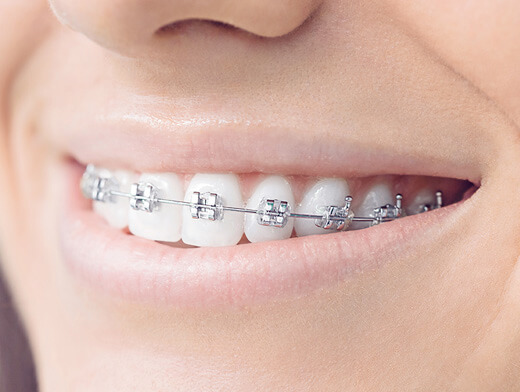 Fixed Braces Kidlington | Ridentes Orthodontics | Specialist Orthodontist